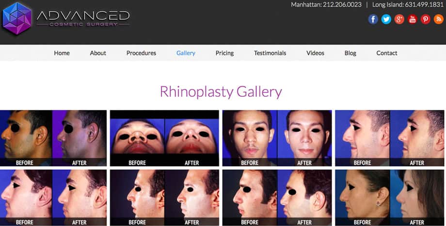 Rhinoplasty Gallery